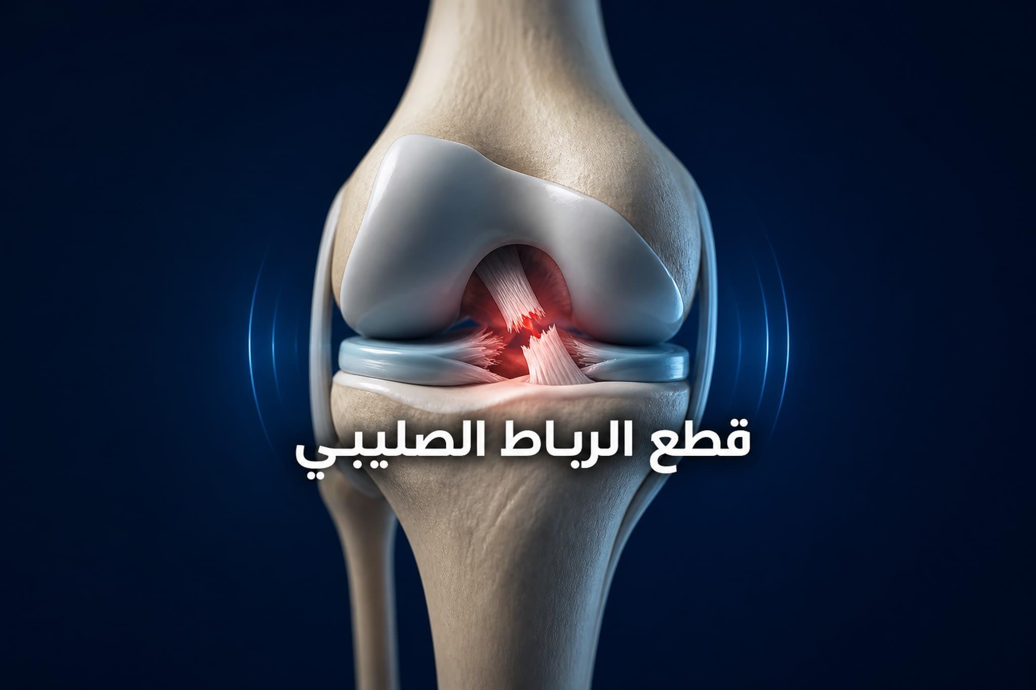 قطع الرباط الصليبي الأمامي: الأسباب، الأعراض، الدرجات وطرق العلاج